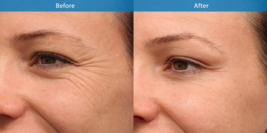 <h3>Case 1</h3><p>Anti wrinkle injections are used to soften the crow’s feet. The end result showcasing a smooth improvemen no tell-tale signs of any treatment. “ Every one will notice, But No one will know “</p><p>Long term use will reduce permanent lines ( crow’s feet) on the side of the eyes.</p>