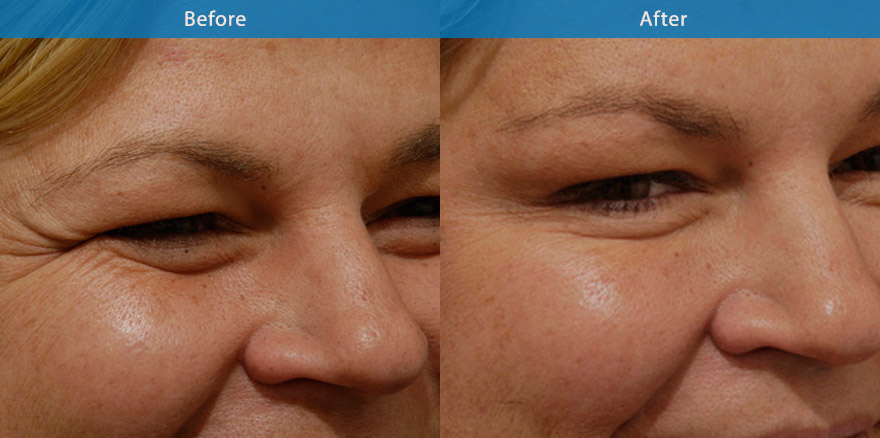 <h3>Case 2</h3><p>Anti wrinkle injections are used to soften the crow’s feet. The end result showcasing a smooth improvemen no tell-tale signs of any treatment. “ Every one will notice, But No one will know “</p><p>Long term use will reduce permanent lines ( crow’s feet) on the side of the eyes.</p>