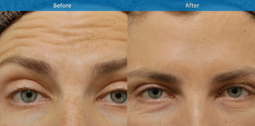 <h3>Case 1</h3><p>Anti wrinkle injections on the forehead to soften the forehead lines creating a refreshed “ non frozen” forehead. </p>