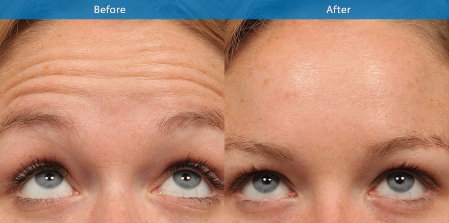 <h3>Case 2</h3><p>Anti wrinkle injections on the forehead to soften the forehead lines creating a refreshed “ non frozen” forehead. </p>