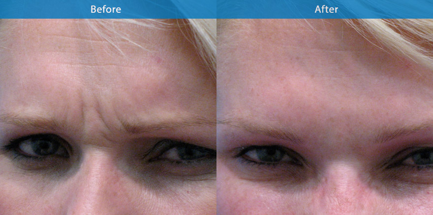 <h3>Case 1</h3><p>Anti wrinkle injections are used to soften the frown lines. The end result showcasing a natural shape eyebrow with no tell-tale signs of any treatment. “ Every one will notice, But No one will know “</p>