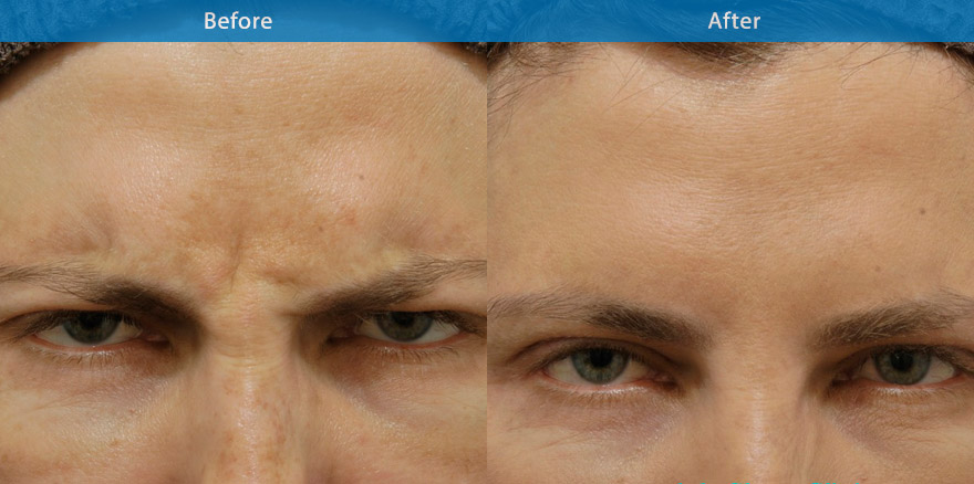 <h3>Case 2</h3><p>Anti wrinkle injections are used to soften the frown lines. The end result showcasing a natural shape eyebrow with no tell-tale signs of any treatment. “ Every one will notice, But No one will know “ </p>
