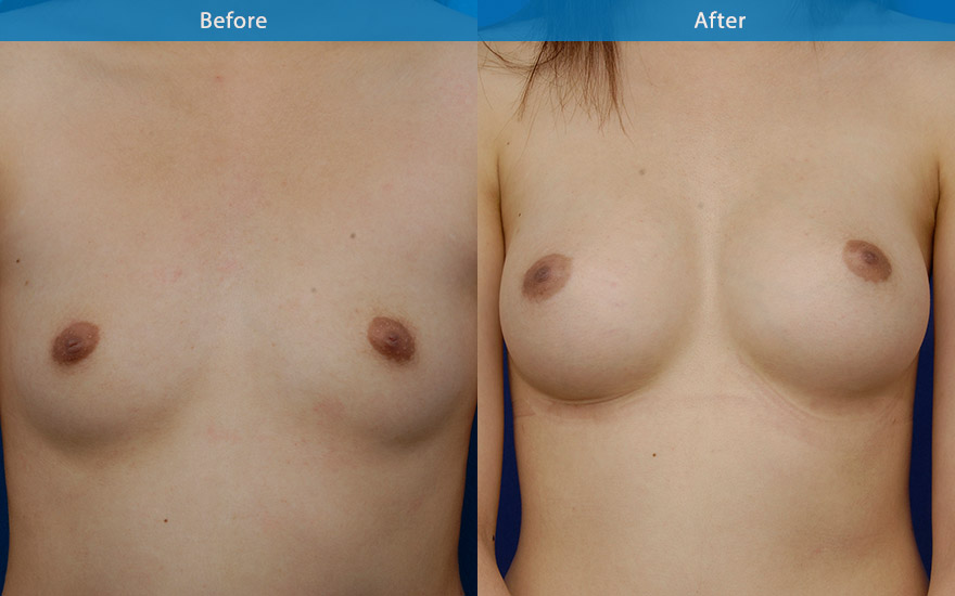 <h3>Case 1</h3><p>A tear drop implant was used on this lady due to minimal pre-exisitng breast shape. The end result is a conservative and natural B cup transformation as requested.</p>