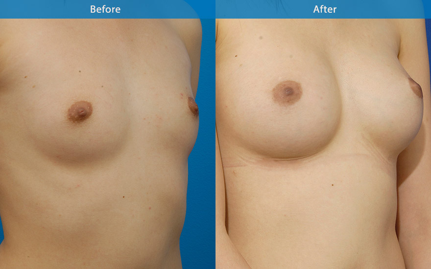 <h3>Case 1</h3><p>A tear drop implant was used on this lady due to minimal pre-exisitng breast shape. The end result is a conservative and natural B cup transformation as requested.</p>