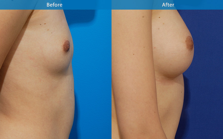 <h3>Case 1</h3><p>A tear drop implant was used on this lady due to minimal pre-exisitng breast shape. The end result is a conservative and natural B cup transformation as requested.</p>