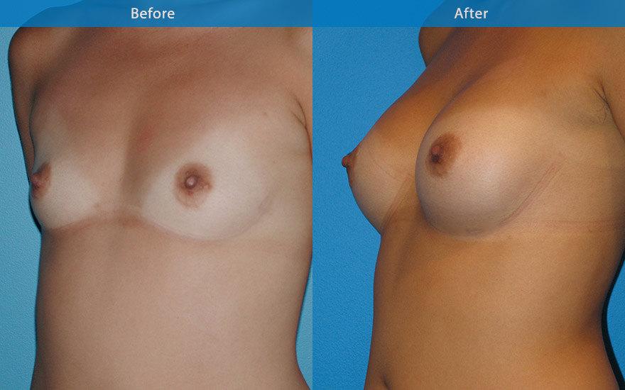 <h3>Case 2</h3><p><strong>Patient details:</strong></p><p>26 female, very athletic, enjoying running marathon. Like to have a conservative breast enhancement so that she can continue her current active athletic lifestyle. Just want to fit into my clothing better, without having to have lots of room in my push-up bra</p><p><strong>Surgical Plan</strong></p><p>Pre-surgical assessment revealed minor amount of breast tissue that has reasonable breast form. A moderate profile 250 gm round implant placed strategically to create a modest B cup as requested. The enhanced breast harmonised with her existing petite body frame as well as allowing her to continue her athletic lifestyle.</p>