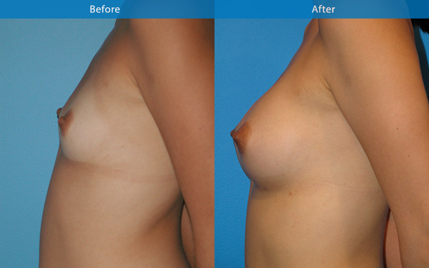 <h3>Case 2</h3><p><strong>Patient details:</strong></p><p>26 female, very athletic, enjoying running marathon. Like to have a conservative breast enhancement so that she can continue her current active athletic lifestyle. Just want to fit into my clothing better, without having to have lots of room in my push-up bra</p><p><strong>Surgical Plan</strong></p><p>Pre-surgical assessment revealed minor amount of breast tissue that has reasonable breast form. A moderate profile 250 gm round implant placed strategically to create a modest B cup as requested. The enhanced breast harmonised with her existing petite body frame as well as allowing her to continue her athletic lifestyle.</p>