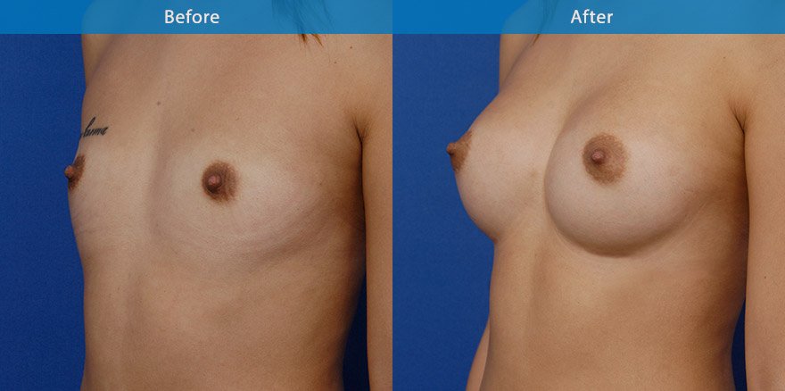 <h3>Case 3</h3><p><strong>Patient details:</strong></p><p>25 Asian female requested a moderate breast enlargement that look as natural as possible</p><p><strong>Surgical Plan</strong></p><p>This lady has minor amount of breast tissue. She has firm thick skin and wide upper chest like those of a swimmer. She has minimal natural cleavage. Breast enhancement in this case involved the use of 270gm moderate profile round implants to create some degree of fullness to the upper part of her breasts and cleavage without giving her too much side breasts which may further widen her upper chest and run the risk of making her top heavy. The end result is a small C cup as requested. The front and profile view showed an aesthetically pleasing and natural breast form. The new breasts harmonise and accentuate the beautiful hour-glass female body form.</p>