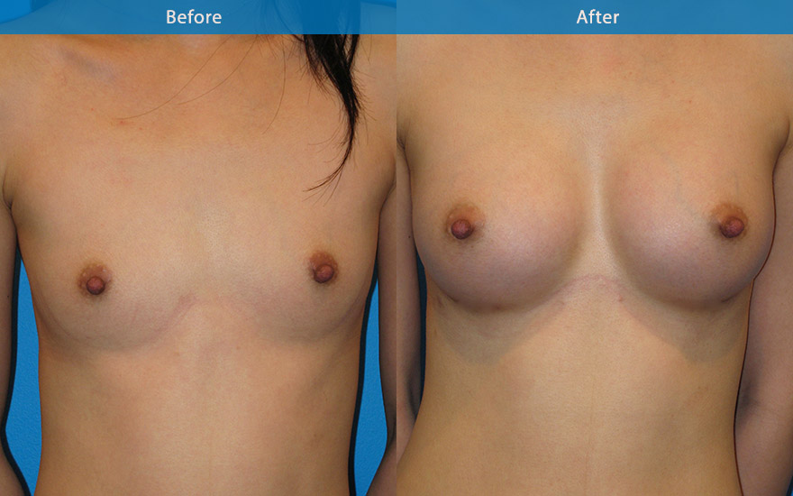 <h3>Case 4</h3><p><strong>Patient details:</strong></p><p>27 female requested a moderate breast enlargement that look as natural as possible. “I am doing it for myself and I just want to fit into most clothing and look nice”</p><p><strong>Surgical Plan</strong></p><p>This lady has virtually no breast tissue apart from skin and some muscle covering her rib cage. As a result, her breast and body exhibits lack of female form. Breast enhancement in this case involved the use of a 280gm tall tear-drop implant to recreate the breast shape. and to match her long chest. The end result is a full B cup as requested. The front and profile view showed an aesthetically pleasing and natural breast form. The new breasts not only camouflage the ribcage but also harmonise and create the beautiful hour-glass female body form.</p>