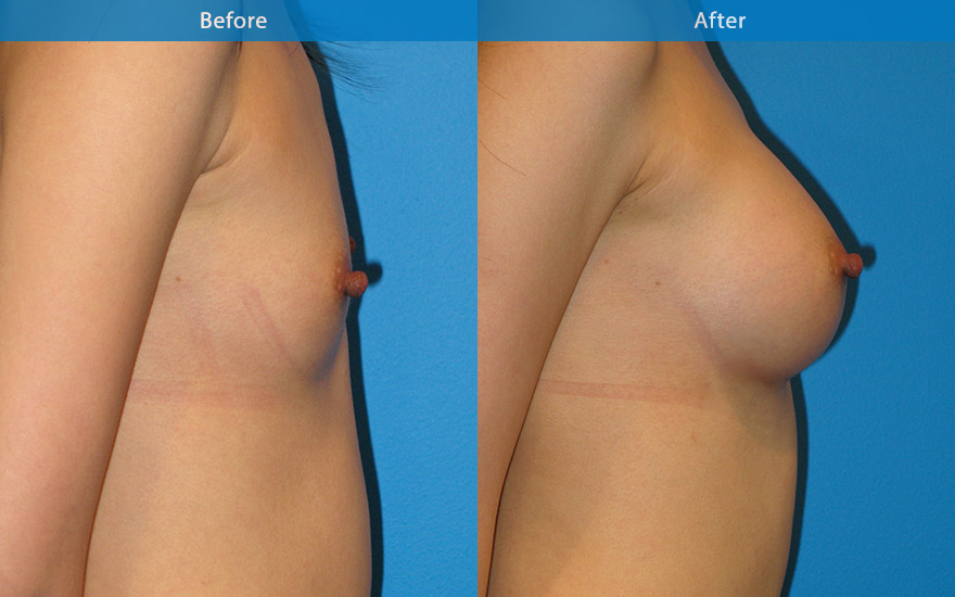 <h3>Case 4</h3><p><strong>Patient details:</strong></p><p>27 female requested a moderate breast enlargement that look as natural as possible. “I am doing it for myself and I just want to fit into most clothing and look nice”</p><p><strong>Surgical Plan</strong></p><p>This lady has virtually no breast tissue apart from skin and some muscle covering her rib cage. As a result, her breast and body exhibits lack of female form. Breast enhancement in this case involved the use of a 280gm tall tear-drop implant to recreate the breast shape. and to match her long chest. The end result is a full B cup as requested. The front and profile view showed an aesthetically pleasing and natural breast form. The new breasts not only camouflage the ribcage but also harmonise and create the beautiful hour-glass female body form.</p>