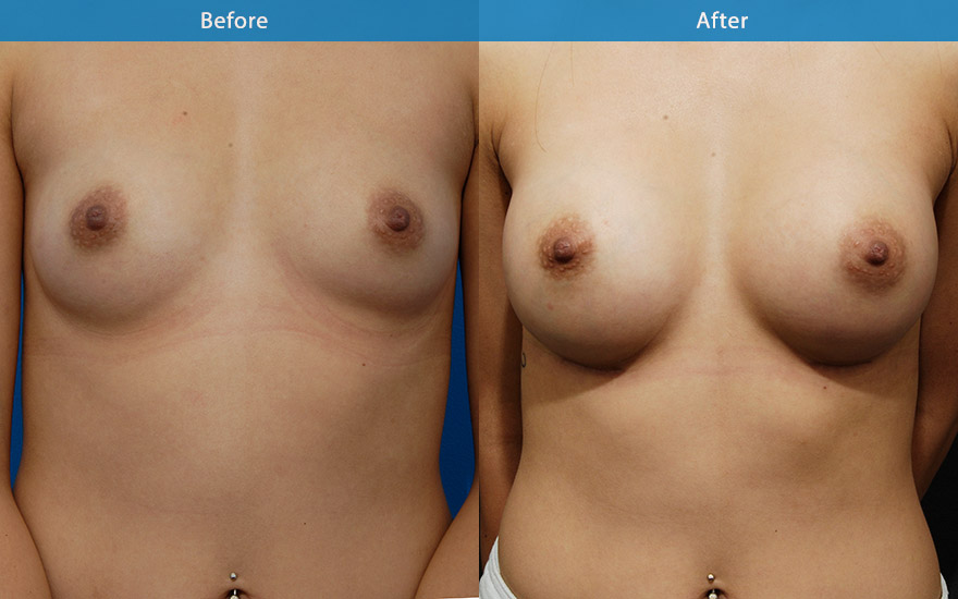 <h3>Case 5</h3><p><strong>Patient details:</strong></p><p>26 Asian female requested a moderate breast enlargement that look as natural as possible. Like some moderate fullness to the upper chest</p><p><strong>Surgical Plan</strong></p><p>This lady has small and fairly straight masculine body shape. Moderate round implants were chosen to provide fullness and some slight side breast fullness to feminise the overall physical shape of her body without excessive widening of her chest. A beautiful C cup brests were achieved to complement the rest of her body.</p>