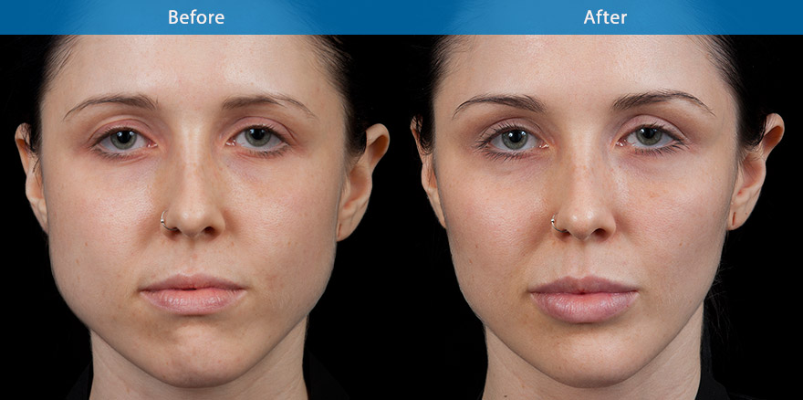 <h3>20's - Case 1</h3><p>29 F, underwent total facial beautification with combination of dermal fillers and anti-wrinkle treatments, transforming her to a model look with brighter eyes, higher cheek bone and better defined jawlines. Her skin is brighter and healthier with simple customised skin care regime.</p>