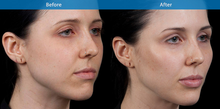 <h3>20's - Case 1</h3><p>29 F, underwent total facial beautification with combination of dermal fillers and anti-wrinkle treatments, transforming her to a model look with brighter eyes, higher cheek bone and better defined jawlines. Her skin is brighter and healthier with simple customised skin care regime.</p>