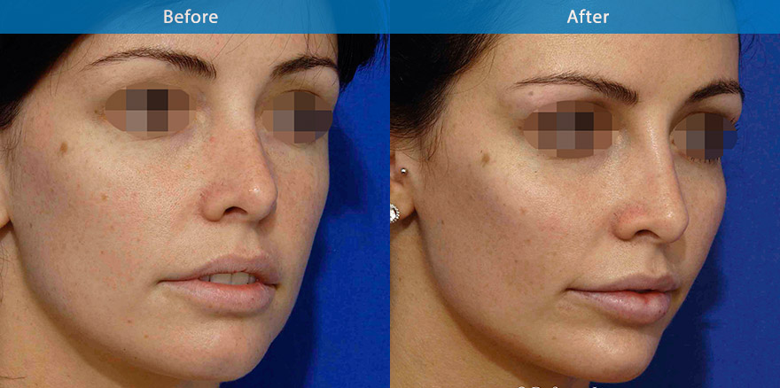 <h3>20's - Case 2</h3><p>27 F, model who felt that   her model face portfolio ( after photoshop) looked  much better than her day to day appearance. She underwent total facial beautification with combination of dermal fillers and anti-wrinkle treatments, creating  glamour eyes with youthful model eye appearance, a more sculpted cheek and a re-contoured  lower and jawline. </p></p>The end results   showcase a transformation from that of the girl next door to runway model appearance with out the need of digital photo touch up.</p>