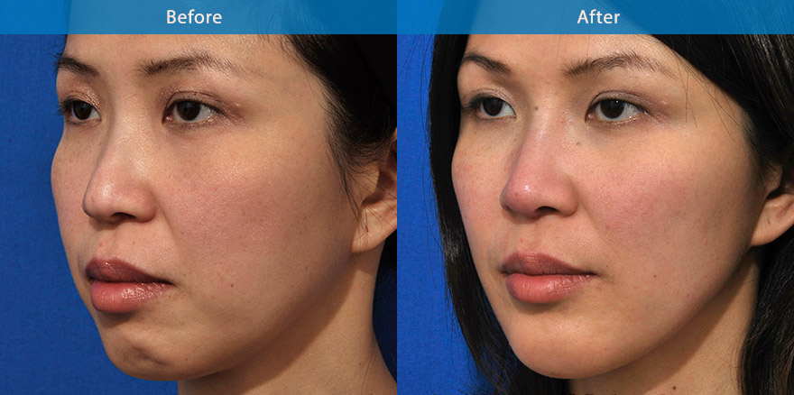 <h3>30's - Case 1</h3><p>38 Asian lady , mother of two, underwent total facial beautification with combination of dermal fillers, anti-wrinkle treatments and laser treatment for facial capillaries. </p></p>The end results   showcase the power of dermal fillers and antiwrinkle treatments in beautify and improve the facial structures. She looks brighter and more beautiful with better definition of the  nose , chin and cheek . A nonsurgical mummy facial make over.</p>