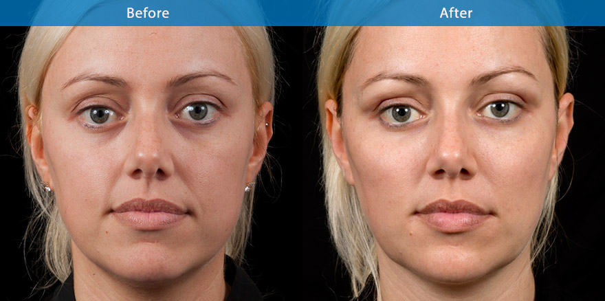<h3>30's - Case 2</h3><p>39, mother of two, underwent total facial beautification with combination of dermal fillers, anti-wrinkle treatments and basic skin care regime prescribed by Dr Liew. </p></p>The end results   showcase the power of dermal fillers and antiwrinkle treatments in improving the facial shape and creating the lifting of the whole face. She looks brighter , fresher and more beautiful with better definition  of the eyes, cheek and lips.  A nonsurgical mummy facial make over.</p>