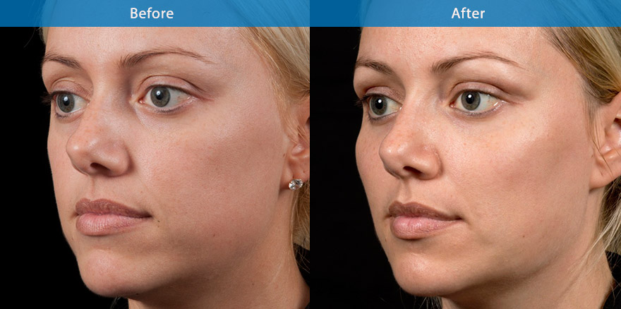 <h3>30's - Case 2</h3><p>39, mother of two, underwent total facial beautification with combination of dermal fillers, anti-wrinkle treatments and basic skin care regime prescribed by Dr Liew. </p></p>The end results   showcase the power of dermal fillers and antiwrinkle treatments in improving the facial shape and creating the lifting of the whole face. She looks brighter , fresher and more beautiful with better definition  of the eyes, cheek and lips.  A nonsurgical mummy facial make over.</p>