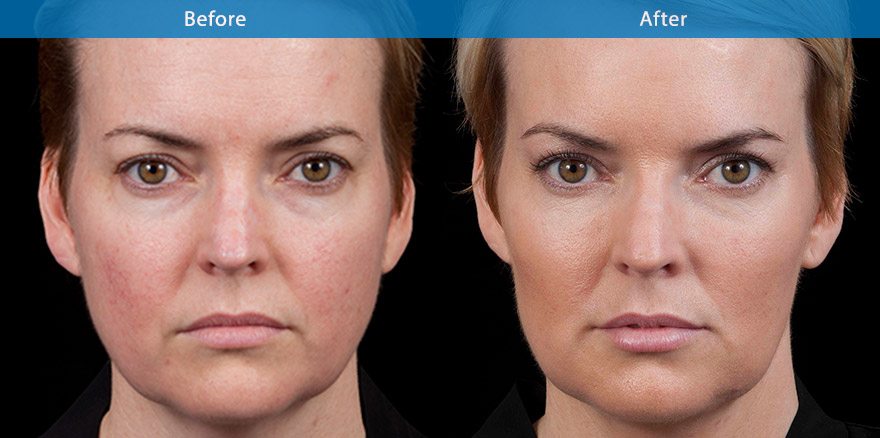 <h3>40's - Case 1</h3><p>42 F, underwent total facial beautification with combination of dermal fillers, anti-wrinkle treatments and laser treatment for facial capillaries. </p></p>The end results  showcase the power of dermal fillers and antiwrinkle treatments and  laser in beautify and lifting the lower face .. She looks more beautiful , fresher and brighter skin and  with better definition of the  eyes, cheek, jawline and lips . </p>
