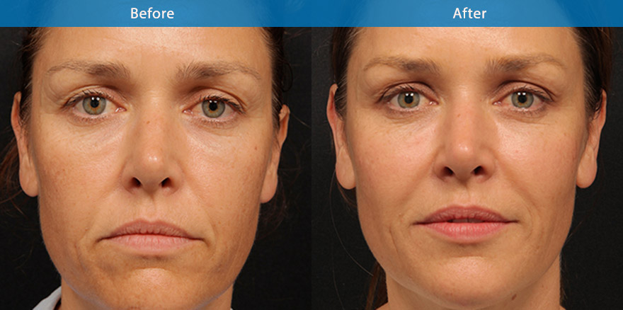 <h3>40's - Case 2</h3><p>43 F, underwent total facial beautification with combination of dermal fillers, anti-wrinkle and laser treatment for pigmentation.</p></p>The end result shows a significant transformation from that of a drawn and tired appearance to that of a refreshed and beautiful version. She looks brighter and more beautiful with better cheek definition and eye appearance. Her skin is smoother and brighter.</p>