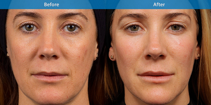 <h3>40's - Case 3</h3><p>44 F, underwent total facial beautification with combination of dermal fillers, anti-wrinkle  and laser treatment for pigmentation.</p></p>She looks brighter, younger and  a more beautiful version of herself ,with fuller cheek , brighter eyes and more proportionate lips.</p>