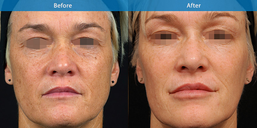 <h3>40's - Case 4</h3><p>48 F, underwent total facial beautification with combination of dermal fillers, anti-wrinkle treatments, laser  for  skin pigmentation and medical grade skin care regime prescribed by Dr Liew.</p></p>The end result shows a significant transformation, resulting in a beautiful version of herself. Her skin is significantly improved, her facial shape is more youthful and triangular and slimmer.  The eyes looks brighter and the lines on her face are softer. Overall , she looks  terrific for her age. </p>