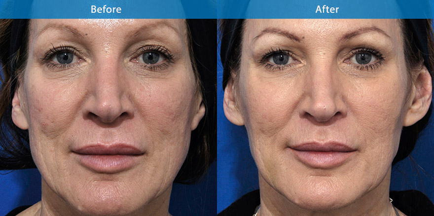 <h3>50's - Case 1</h3><p>58 F, underwent total facial beautification with combination of dermal fillers, anti-wrinkle treatment  and fractionated laser treatment for skin texture.</p></p>The end result shows a nice transformation, where she looks very good for her age, more feminine, slimmer lower face, better jawline and fresher eye appearance. Her skin looks finer following laser treatment and customised skin care regime by Dr Liew</p>