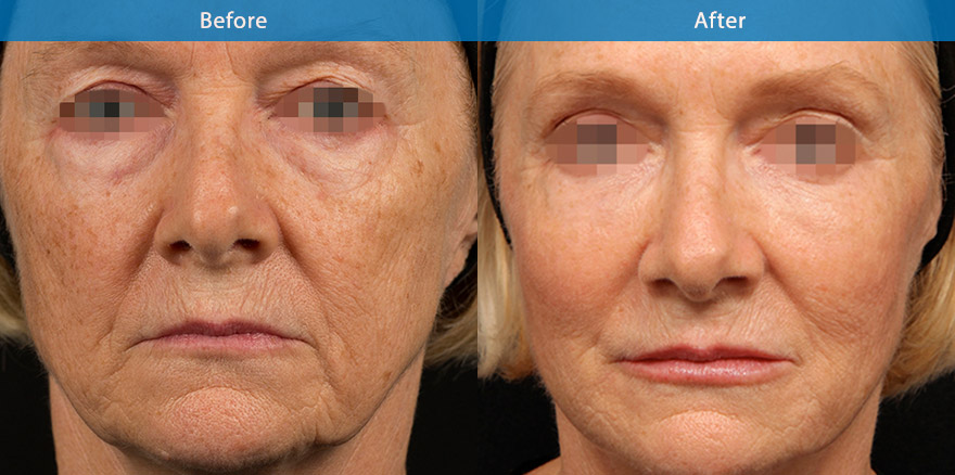 <h3>60's - Case 1</h3><p>63 F, underwent total facial beautification with combination of dermal fillers, anti-wrinkle and skin care treatment</p></p>The end result shows a significant transformation from that of a drawn and tired and sad appearance to that of a refreshed, more youthful and  beautiful version. She looks brighter , her skin is less wrinkled with better skin texture. Her cheek , eyebrow and eyelids are lifted. Her lower eyebags has been made less visible. Her lips has been gently plumped. Overall she  is looking terrific and the best for her age.</p>