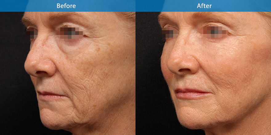 <h3>60's - Case 1</h3><p>63 F, underwent total facial beautification with combination of dermal fillers, anti-wrinkle and skin care treatment</p></p>The end result shows a significant transformation from that of a drawn and tired and sad appearance to that of a refreshed, more youthful and  beautiful version. She looks brighter , her skin is less wrinkled with better skin texture. Her cheek , eyebrow and eyelids are lifted. Her lower eyebags has been made less visible. Her lips has been gently plumped. Overall she  is looking terrific and the best for her age.</p>