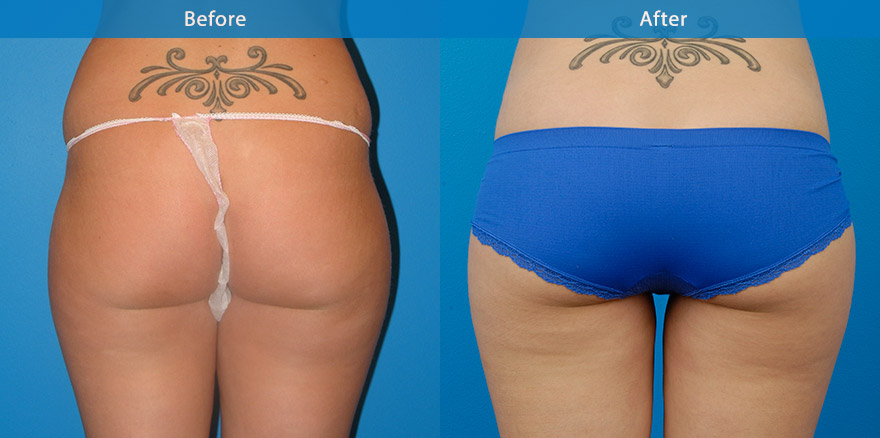 <h3>Case 1</h3><p>This 34 female underwent liposculpting of her hips and thighs. She has  normal BMI. The result at 6 month showing a slender better defined waistline, slimmer and shapely thighs with no tell-tale sign of surgery.</p>