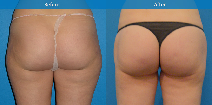 <h3>Case 2</h3><p>Liposculpturing to the outer thighs, hips and buttocks, creating a longer and slimmer waistline ,outer thighs, rounder and perkier buttock. </p>