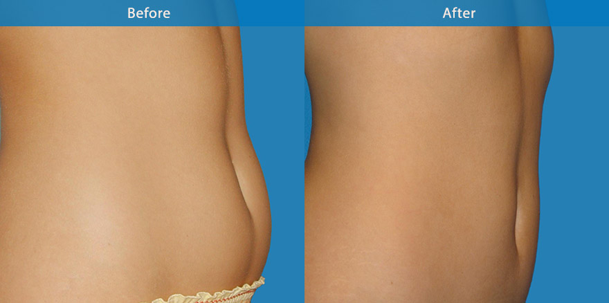 <h3>Case 2</h3><p>Liposculpturing to the outer thighs, hips and buttocks, creating a longer and slimmer waistline ,outer thighs, rounder and perkier buttock. </p>