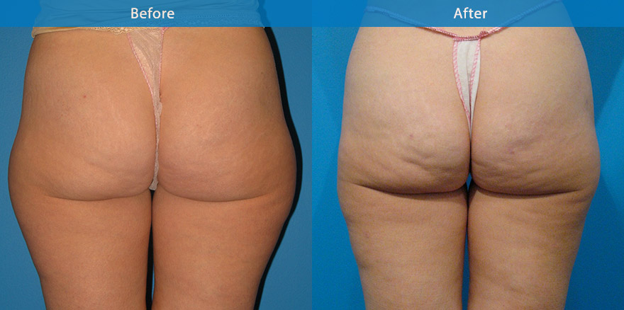 <h3>Case 3</h3><p>Lipo sculpturing to the hips, outer thighs and buttocks, creating a slimmer outer thigh and yet retaining the curvaceous feminine figure and a rounder buttock.</p>