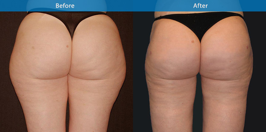 <h3>Case 4</h3><p>Deep and Superficial lipo-sculpturing of the hips, inner and outer thigh, creating balance and a more harmonious shape to the upper body.</p>