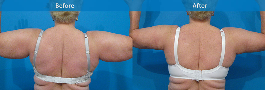 <h3>Case 1</h3><p>Ageing and repeated weight fluctuations can lead to excess skin hanging from the upper arms – a condition commonly referred to as “bat wings” or “tuckshop” arms. </p><p>An upper arm lift – generally combined with liposculpting - reshapes the skin underneath the upper arm, giving a firmer and more toned appearance. The incision is placed either in the armpit ( short scar ) or along the back of the arm depending on the severity of the excess skin.</p>