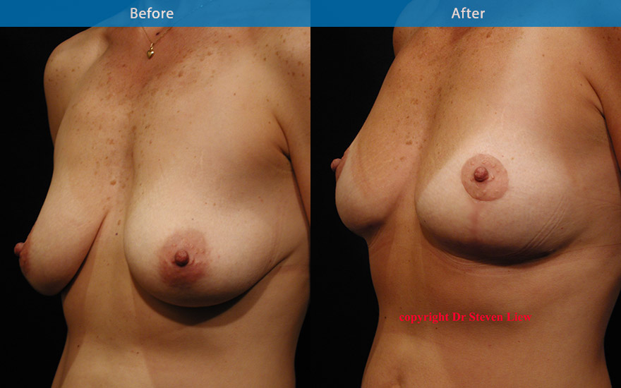 <h3>Case 1</h3><p>46 F who requested breast lift to uplift the breasts and NO breast implant. A mastopexy was performed to uplift and reshape her breast. At 6 month, the breast is perkier and the scar is expected to settle and fade even more with time.</p>