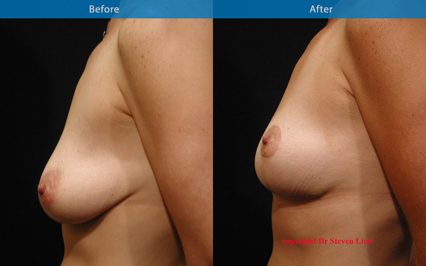 <h3>Case 1</h3><p>46 F who requested breast lift to uplift the breasts and NO breast implant. A mastopexy was performed to uplift and reshape her breast. At 6 month, the breast is perkier and the scar is expected to settle and fade even more with time.</p>