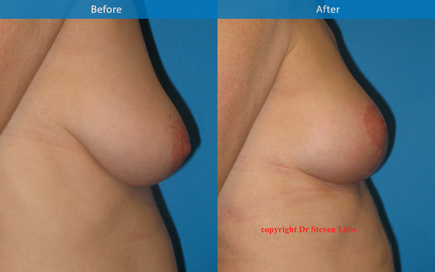 <h3>Case 2</h3><p>47  F who requested breast lift to uplift and slight  increased in  fullness to the breasts and NO breast implant. A mastopexy was performed to uplift and reshape her breast. At 8 weeks, the breast is perkier , rounder  and the scar is expected to settle and fade with time.</p>