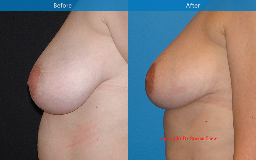 <h3>Case 3</h3><p>43  F who requested breast lift to uplift and to reduce some fullness from the lower part and slight increase in fullness to the upper part of  the breasts and NO breast implant. A mastopexy was performed to uplift and reshape her breast. The breast is perkier , and the nipple is lifted by 3 cm</p>