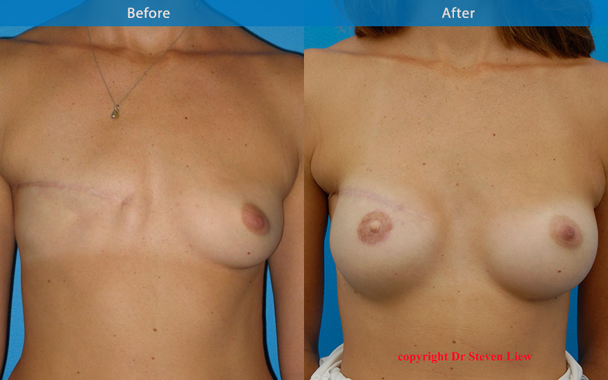 <h3>Case 1</h3><p>A young  lady who opted for a delayed  2 stage left  breast reconstruction with tissue expander and breast implant and left augmentation following mastectomy. The  result at 6 months post surgery showcasing an aesthetically pleasing and natural results.</p>