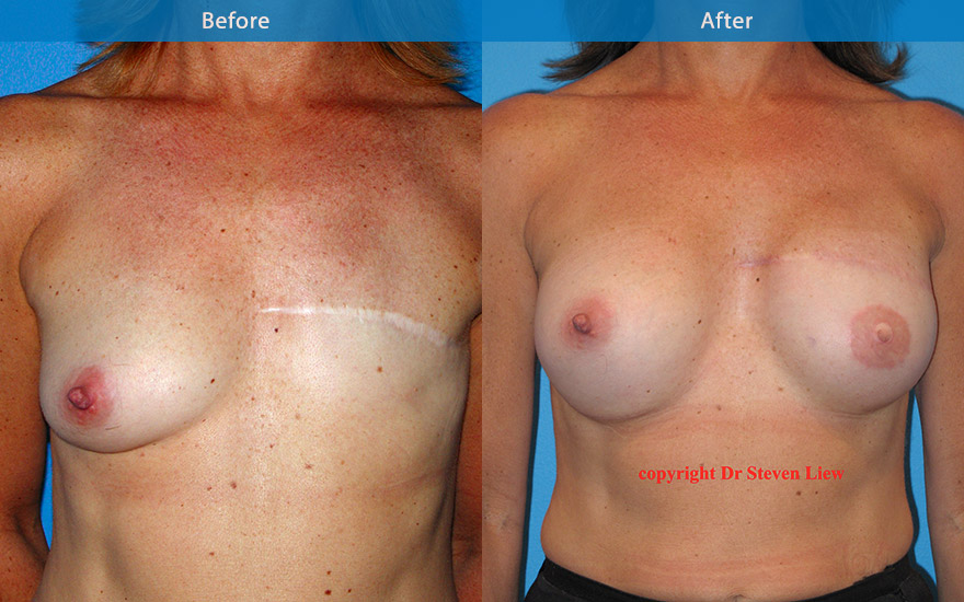 <h3>Case 2</h3><p>A middle age lady who opted for 2 stage left  breast reconstruction with tissue expander and breast implant and right augmentation following mastectomy. The  result at 3 months post surgery showcasing an aesthetically pleasing and natural results.</p>