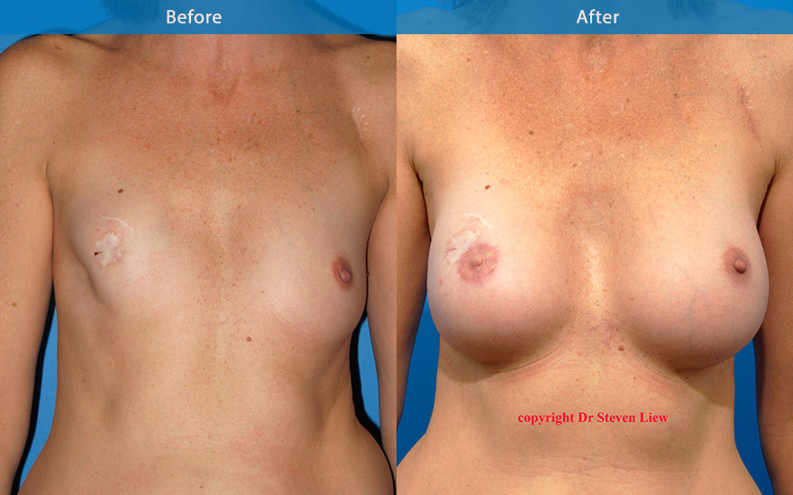 <h3>Case 4</h3><p>A young lady who “had breast reconstruction” following mastectomy overseas. A revision right breast reconstruction and left augmentation for symmetry with tear drop implants , followed by nipple areola reconstruction, creating a very natural breast shape and form.</p>