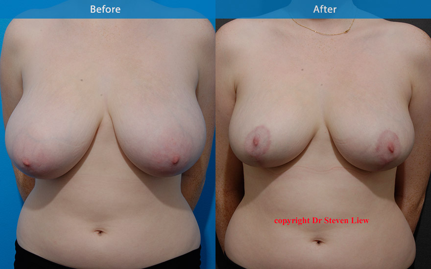 <h3>Case 1</h3><p>21 F with E cup breasts. A proportionate breast reduction was performed to reshape and to reduce the breasts to that of  D cup. The nipples were lifted and the breasts are in better balance with the body.</p>