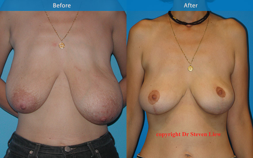 <h3>Case 2</h3><p>Middle age lady with pendulous and asymmetrical breasts. Breast reduction and breast lift surgery was performed to reduce and uplift the breast and areola to that of a more symmetrical and balanced breast shape and form.</p>