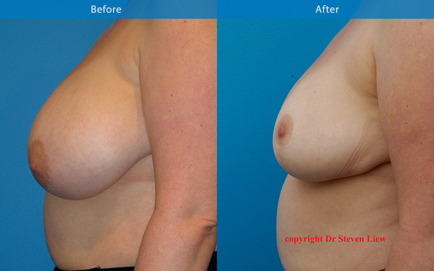 <h3>Case 3</h3><p>Middle age lady with pendulous and asymmetrical breasts. Breast reduction and breast lift surgery was performed to reduce and uplift the breast and areola to that of a more symmetrical and balanced breast shape and form.</p>