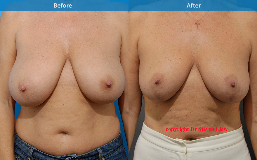 <h3>Case 4</h3><p>Middle age lady with pendulous and asymmetrical breasts. Breast reduction and breast lift surgery was performed to reduce and uplift the breast and areola to that of a more symmetrical and balanced breast shape and form.</p>