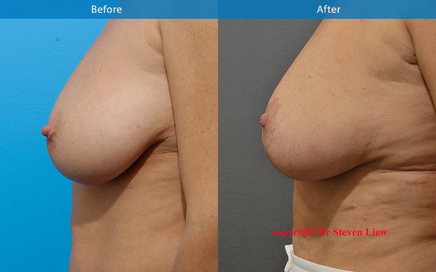 <h3>Case 4</h3><p>Middle age lady with pendulous and asymmetrical breasts. Breast reduction and breast lift surgery was performed to reduce and uplift the breast and areola to that of a more symmetrical and balanced breast shape and form.</p>