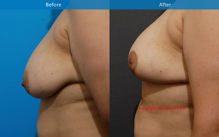 <h3>Case 6</h3><p>This lady requested breast reduction, breast lift and reshaping of her breasts. The post surgical result shows a more youthful, perkier breasts with reshaping of her breasts to that of an aesthetically more optimal form.</p>