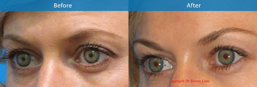 <h3>Case 1</h3><p>36 year old lady underwent eyebrow lifting with the use of antiwrinkle injections.</p>