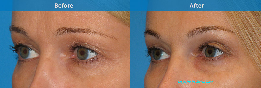 <h3>Case 2</h3><p>40  year old lady with flattening of the eyebrow and some loose skin to the upper eyelids. She underwent eyebrow lifting and shaping with antiwrinkle injection and dermal fillers placed on the surface of the eye socket.</p><p>The end result shows  beautiful lifting and reshaping of the eyebrows. The loose skin on the eyelids has also been nicely lifted. She looks brighter and her eyes appeared fresher and bigger.</p>