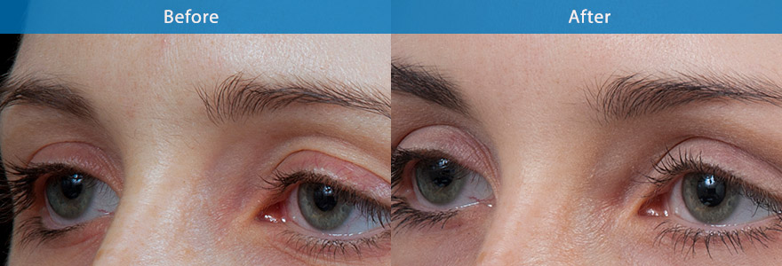 <h3>Case 3</h3><p>Dermal filler is used to reshape the downturn eyebrows which has impart a sad appearance. </p><p>The end result shows  lifting of the corner of the eyes reducing the excess eyelid skin.</p>